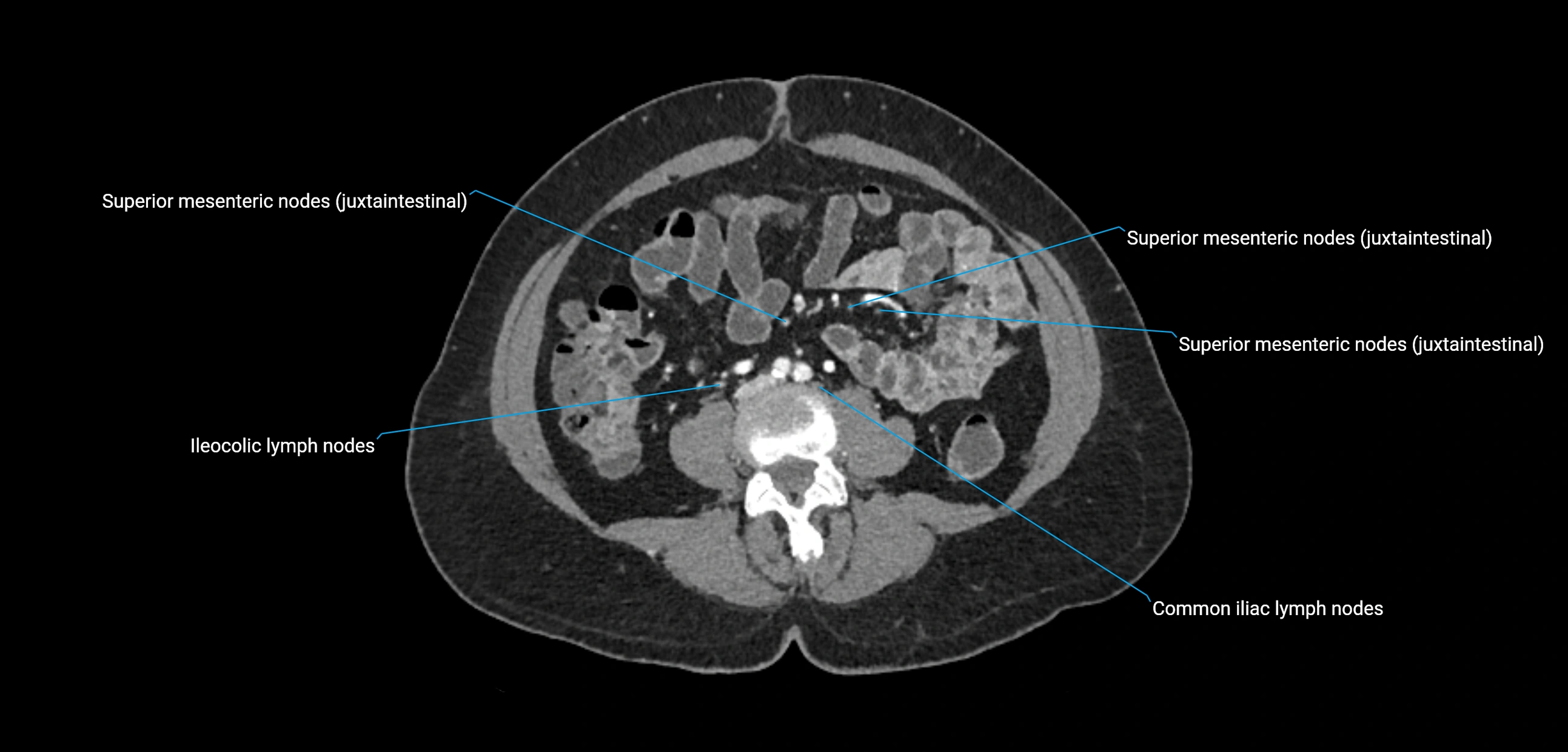 CT ct abdominal lymph nodes  axial cross sectional anatomy  enchanced radiology image -img-00002-00258.webp